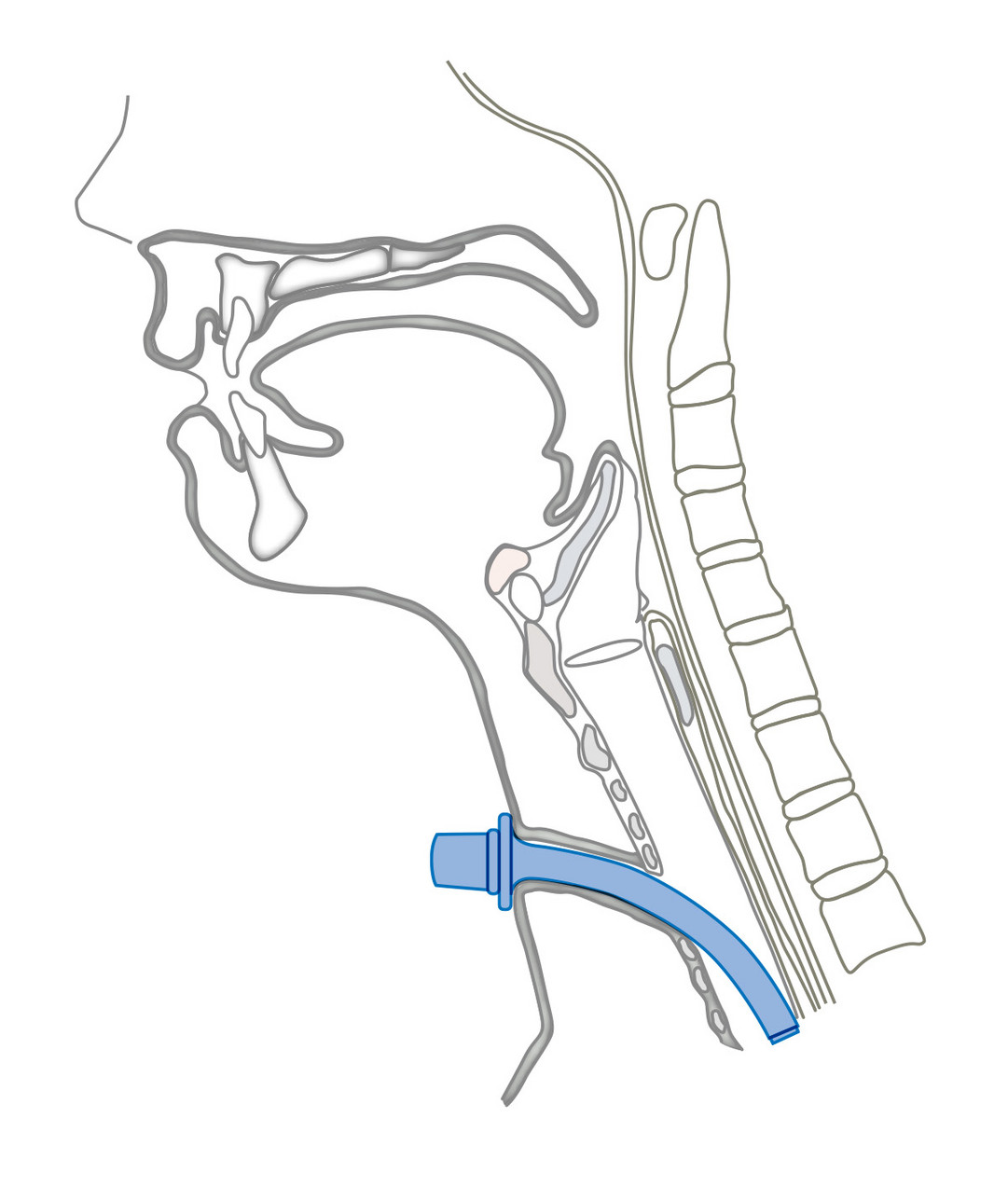 Moore Trachealkanüle