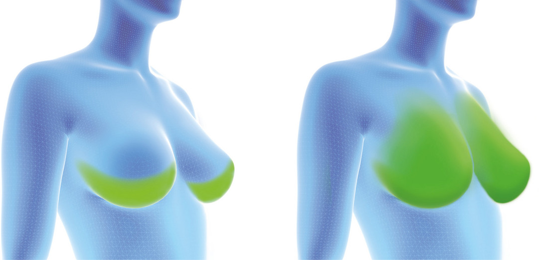 Fortiva® für die Brustrekonstruktion