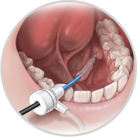 Kolenda Einführset für den Zugang zum Speicheldrüsengang Kolenda Einführset für den Zugang zum Speicheldrüsengang