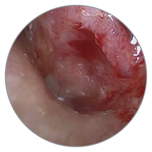 40 Tage nach der OP