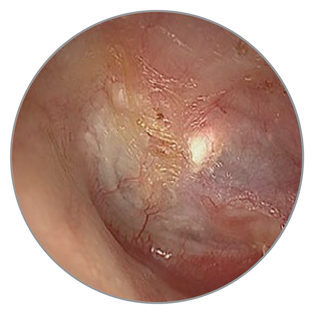 60 Tage nach der OP